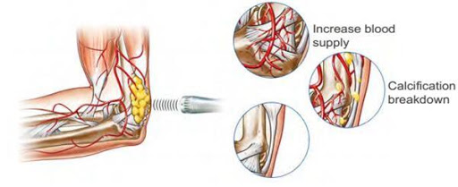 tác động của máy xung kích vào tế bào 